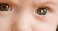 Você sabe o que é o retinoblastoma? Prof. Juliana Pariz explica
